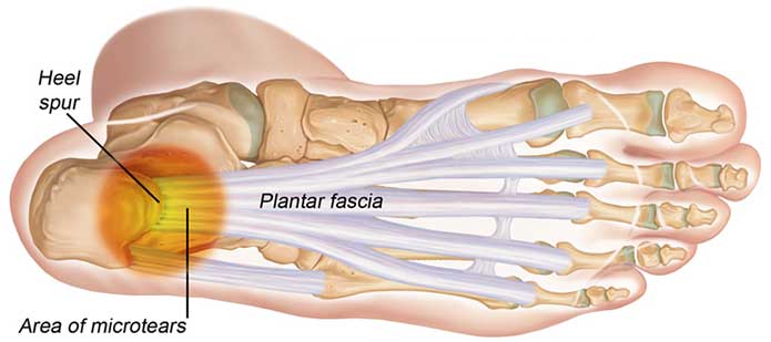 Heel Pain Physical Therapy Specialists